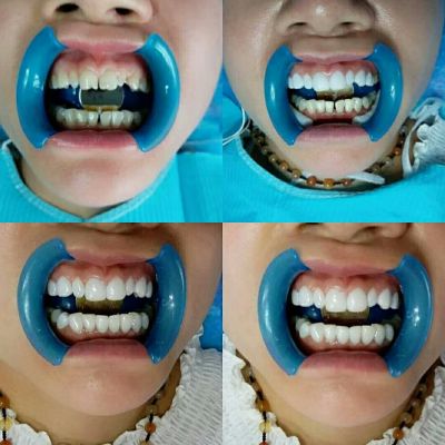 有想要牙白吗加我一下18545736697 了解了解