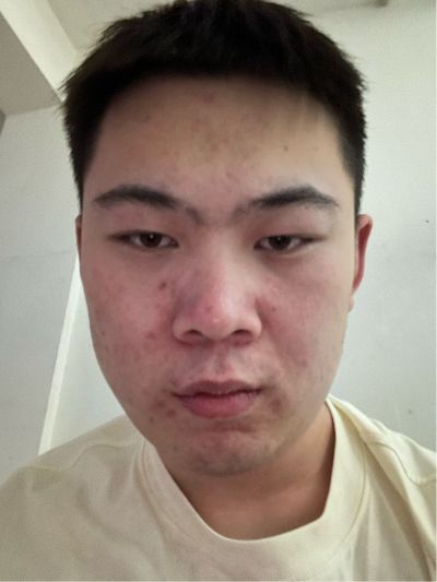 贴面工